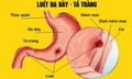 Những nguy cơ khi tự ý dùng meloxicam trị đau xương khớp