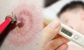Suy đa tạng do mò đốt, đặc trưng của bệnh sốt mò cần biết