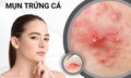 Mụn trứng cá kéo dài tới tuổi nào mới hết?