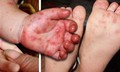 Tay chân miệng tăng nhanh ở Khánh Hòa, bác sĩ khuyến cáo người dân không chủ quan