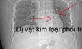 Ho không dứt, bác sĩ phát hiện cán thìa inox mắc trong phế quản bệnh nhân