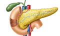 Tăng mỡ máu có thể gây viêm tụy cấp nguy hiểm đến tính mạng