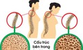 Tuổi nào bắt đầu bị loãng xương và cách phòng bệnh hiệu quả từ sớm
