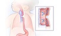 Teo thực quản bẩm sinh cần phát hiện sớm
