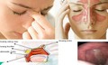 Viêm mũi xoang mùa mưa: Đừng chủ quan với những cơn nghẹt mũi kéo dài