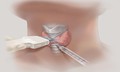 Phát hiện nhân tuyến giáp có nhất thiết phải chọc hút tế bào?