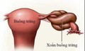 Đau bụng dữ dội, buồn nôn phát hiện xoắn u nang buồng trứng