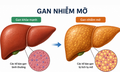 Cách chữa gan nhiễm mỡ độ 1 không dùng thuốc