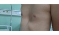 4 dấu hiệu phát hiện lõm ngực bẩm sinh ở trẻ