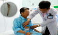 Người đàn ông suýt mất mạng vì mảnh xương đâm thủng dạ dày
