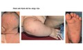 Bé gái 2 tháng tuổi mắc giang mai, nhầm sang viêm da cơ địa
