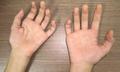 Teo cơ bàn tay ở người trẻ: Cảnh giác với bệnh Hirayama hiếm gặp