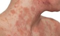 Phân biệt viêm da cơ địa với các bệnh da khác