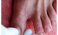 Bệnh ngoài da hay gặp mùa mưa bão