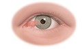 7 dấu hiệu nhận biết xước, rách giác mạc