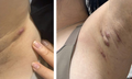 Viêm tuyến mồ hôi mủ dễ nhầm với mụn nhọt, áp xe