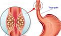 Triệu chứng hẹp thực quản: Đừng chủ quan khi thường xuyên nuốt nghẹn