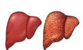 Các xét nghiệm cần làm để kiểm tra, đánh giá mức độ gan nhiễm mỡ