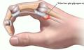 Ngón tay đau hoặc bật lò xo, cảnh giác với viêm gân gấp ngón tay