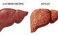 Chưa bị xơ gan vẫn có thể mắc ung thư gan