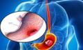 6 dấu hiệu cảnh báo ung thư dạ dày cần biết