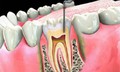 Viêm quanh răng gây hệ lụy gì?

