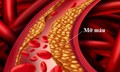 Mỡ máu cao âm thầm hại tim