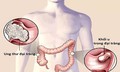 Ung thư đại trực tràng thường di căn đến đâu?