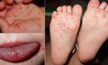 Khánh Hòa đã ghi nhận 3.688 ca tay chân miệng, bác sĩ khuyến cáo điều cần làm