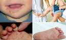 Thông tin mới nhất về bệnh tay chân miệng ở nước ta, 6 khuyến cáo cần nhớ của Bộ Y tế
