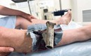 Chân chống xe máy găm cẳng chân, người đàn ông phải mang cả vào phòng cấp cứu