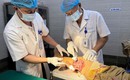 Ghép da tự thân phục hồi vận động cho bệnh nhân bỏng bô