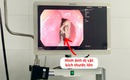 Lấy xương gà kích thước lớn mắc kẹt trong thực quản bệnh nhân