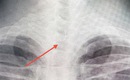 Sau ăn cá người đàn ông 46 tuổi bị mắc lưỡi câu sâu trong thực quản