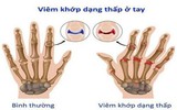 Tìm hiểu bệnh trúng phong là gì và các biểu hiện đi kèm