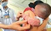 Đ&#227; ghi nhận 42 ca mắc bệnh sởi, Bộ Y tế y&#234;u cầu gi&#225;m s&#225;t ph&#225;t hiện sớm, xử l&#253; triệt để ổ dịch