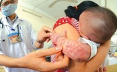 Đ&#227; c&#243; 78 ca sốt ph&#225;t ban nghi sởi, rubella, phải xử l&#253; triệt để ngay khi xuất hiện ca mắc