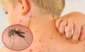 Đ&#227; c&#243; hơn 86.000 ca mắc sốt xuất huyết, bệnh ng&#224;y c&#224;ng kh&#243; lường hơn do biến đổi kh&#237; hậu