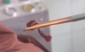Ph&#225;t hiện con vắt sống trong mũi người đ&#224;n &#244;ng suốt nhiều ng&#224;y