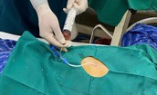 Cứu sống cụ &#244;ng tr&#224;n dịch m&#224;ng ngo&#224;i tim do lao biến chứng