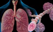 Khoảng 4 triệu người Việt mắc bệnh hen, g&#225;nh nặng bệnh tật kh&#244;ng nhỏ