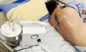 Ca phẫu thuật phức tạp cứu sống người đ&#224;n &#244;ng bị liệt v&#224; nhiễm nấm cột sống