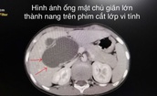 Bệnh viện Trẻ em Hải Ph&#242;ng nội soi cắt nang ống mật chủ lớn cho bệnh nhi 10 tuổi
