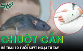 Bị chuột cắn, b&#233; trai 10 tuổi su&#253;t hoại tử tay, phụ huynh cần biết điều n&#224;y để bảo vệ con 