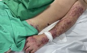 Đ&#227; c&#243; người tử vong v&#236; nhiễm li&#234;n cầu lợn, Bộ Y tế khuyến c&#225;o 6 c&#225;ch ph&#242;ng, chống bệnh