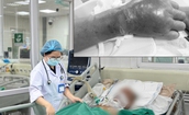 Bị tai nạn lao động nhưng không tiêm phòng uốn ván, bệnh nhân rơi vào nguy kịch