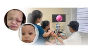 Trẻ 18 tháng tuổi nguy cơ mất thị lực do viêm xoang biến chứng