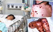 TPHCM ghi nhận ca não mô cầu mới tại xã Thường Tân