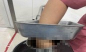 Nữ nhân viên nấu ăn ở trường học bị bàn tay phải cuốn vào máy xay thịt
