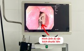 Lấy xương gà kích thước lớn mắc kẹt trong thực quản bệnh nhân